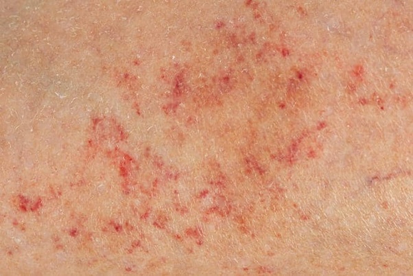 Overview When are Rashes a sign of Cancer