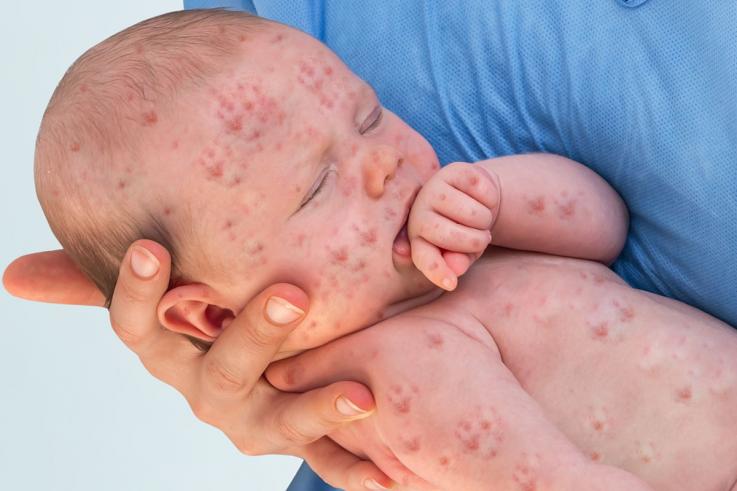 What Should Parents Know About Measles ?